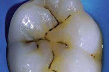 当牙齿出现小白点应该怎么办,当牙齿有黑线条