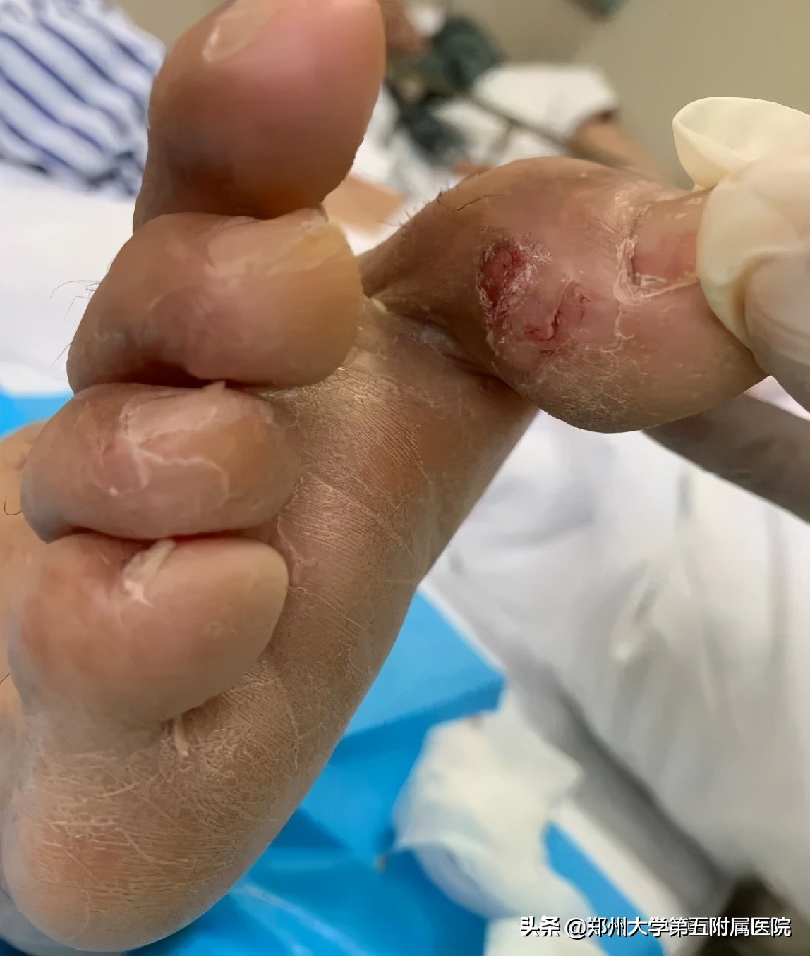 老茧疼痛怎么去除,去除手部老茧