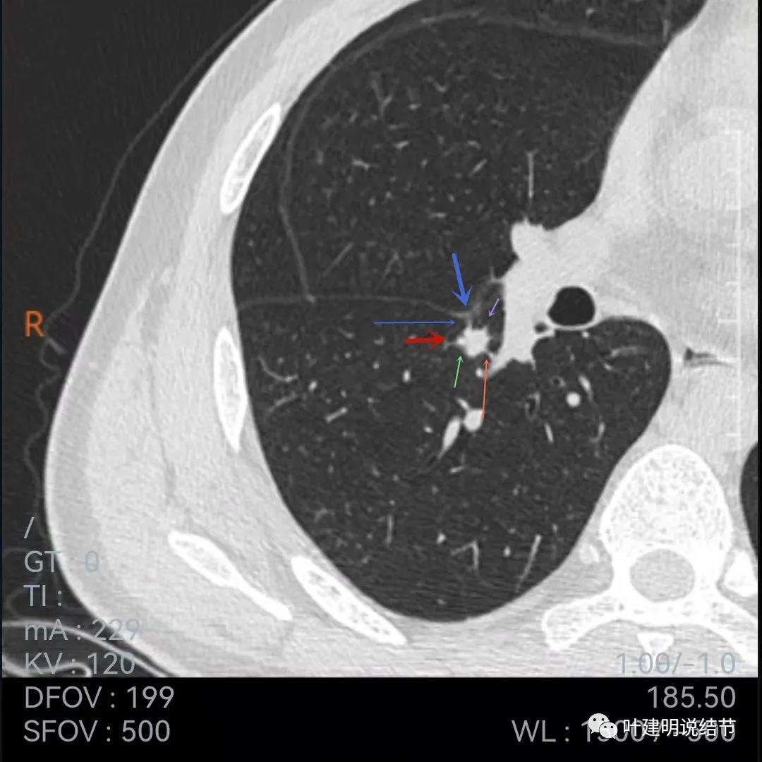问诊分析：存在了4年的实性结节会不会是肺癌？