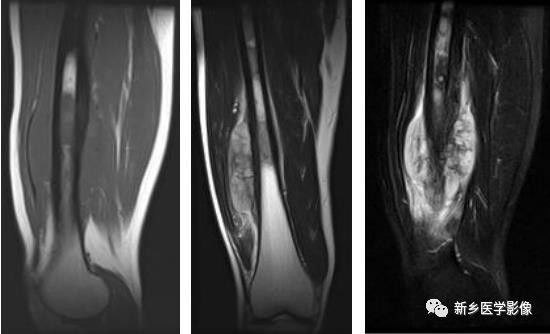 骨骼坏死最佳治疗方法,骨骼疾病治疗