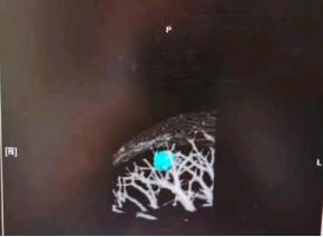 “旧病未愈，又添新症”，9.9mm高危肺结节，手术不犹豫