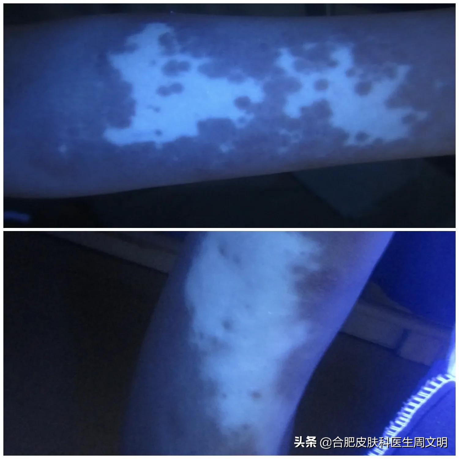 白癜风光疗费用多少能走医保吗,正规白癜风医院费用可以报销吗