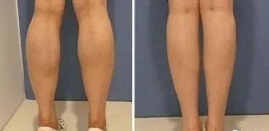 小腿大小不一样粗怎么改善,小腿粗外翻怎么改善