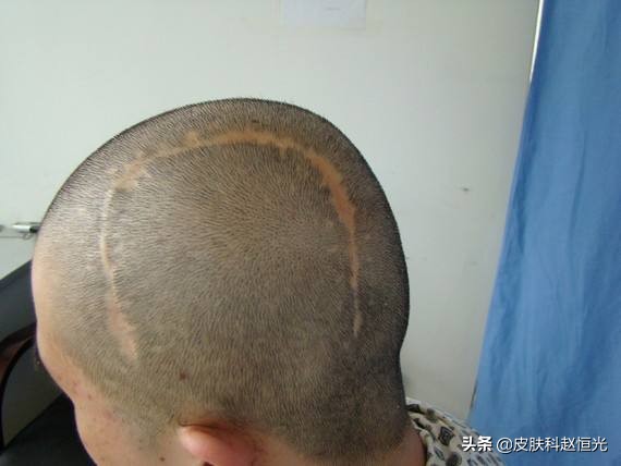 化疗造成的脱发是永久性的脱发吗,梅毒性脱发是一种永久性脱发