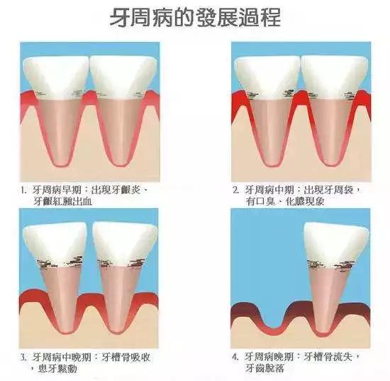 牙科治疗牙龈炎的效果怎么样,Helen齿科中心