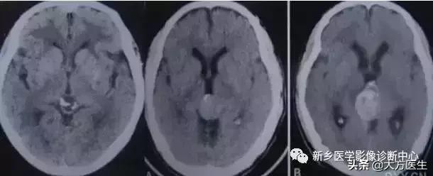 钙化灶是良性肿瘤的可能性大吗,颅内肿瘤钙化发生率最高