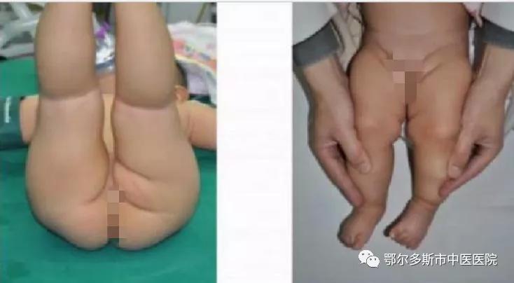 小儿髋关节发育不良都做什么检查,小儿髋关节发育不良超声