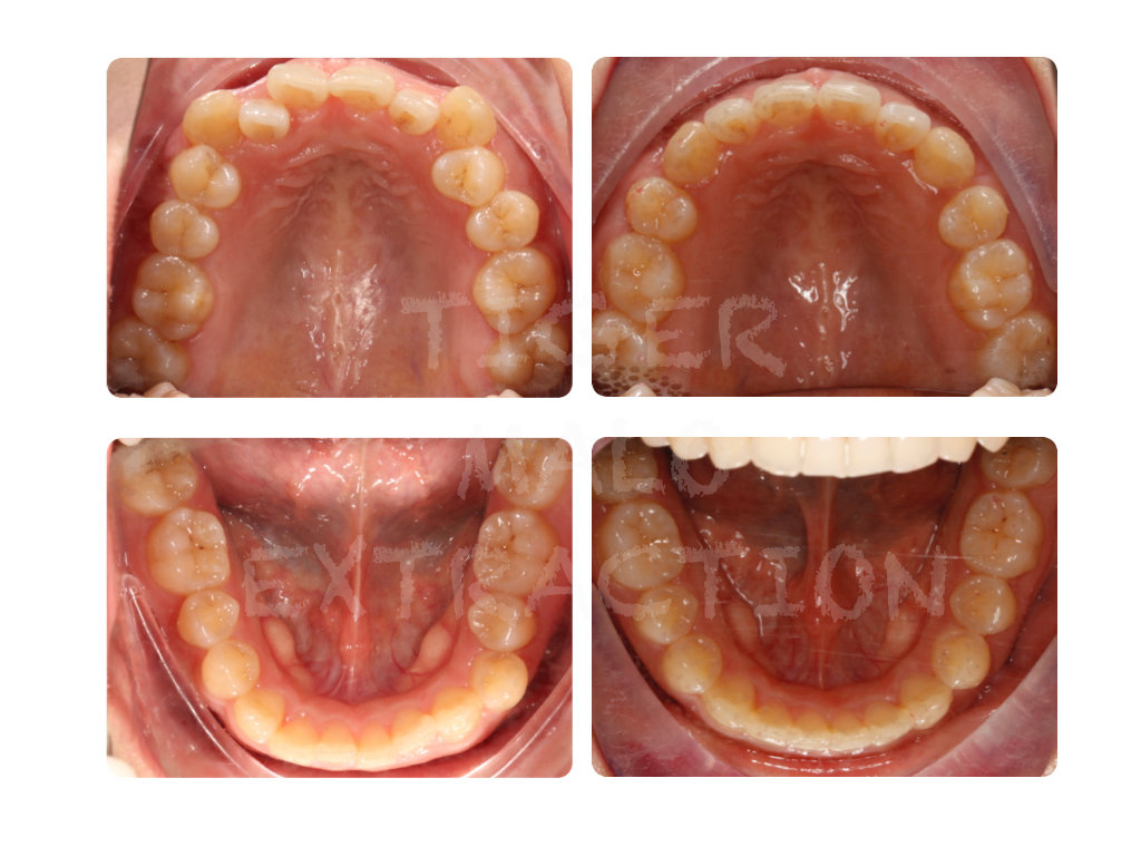 正畸医生邰怡的作品,南京牙齿矫正邰医生