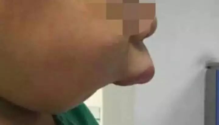 修复一颗蛀牙的全过程,蛀牙早期黑点全治好了的感觉真好