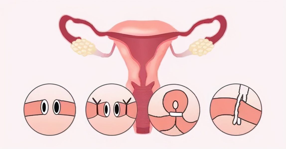 输卵管复通失败可以再复通吗,输卵管复通是什么意思