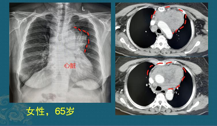 为什么每年体检还会查出癌症晚期,年年体检正常却被诊断为癌症晚期