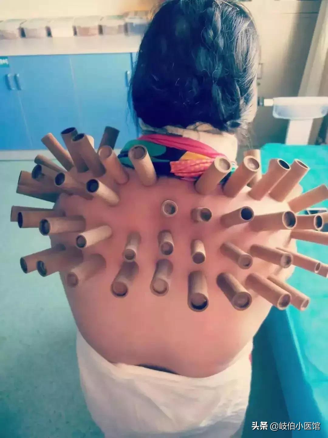 中医火罐疗法有哪些注意事项,中医火罐穴位图