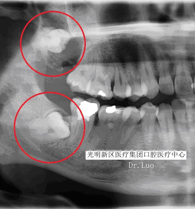 智齿蛀牙痛有什么有效方法止痛,智齿旁边牙松动蛀牙如何处理