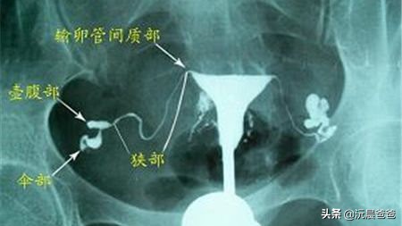 多囊卵巢造影能查出怀孕吗,多囊卵巢造影