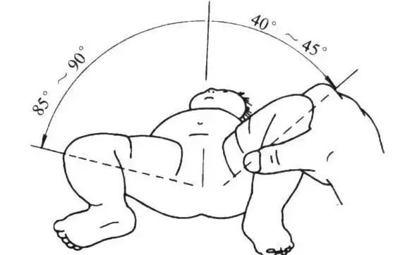 宝宝腿纹不对称是如何造成的,42天皮纹对称两个月后不对称