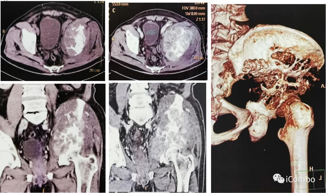 肾癌369例临床分析,恶性肾癌中晚期治疗方案