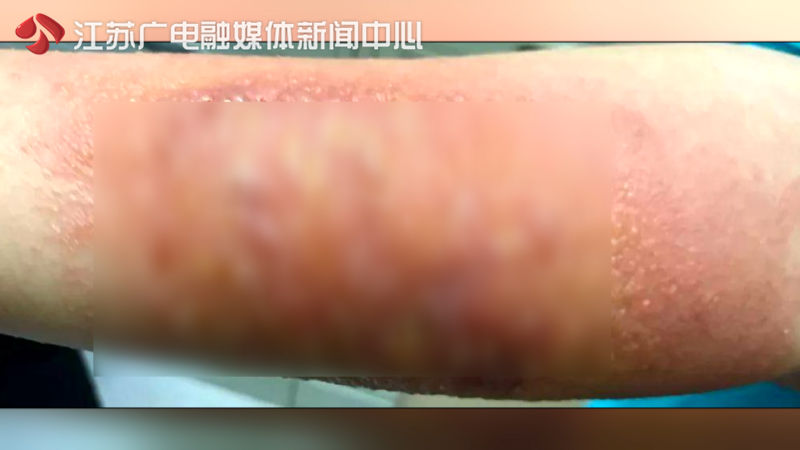 烫伤后涂青草药膏变红正常吗,烫伤后起泡皮破了能涂青草膏吗