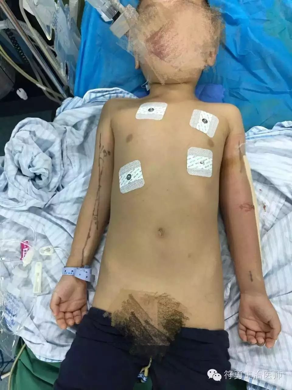 手臂肘内翻的手术效果,胳膊肘内翻矫正手术28年费用