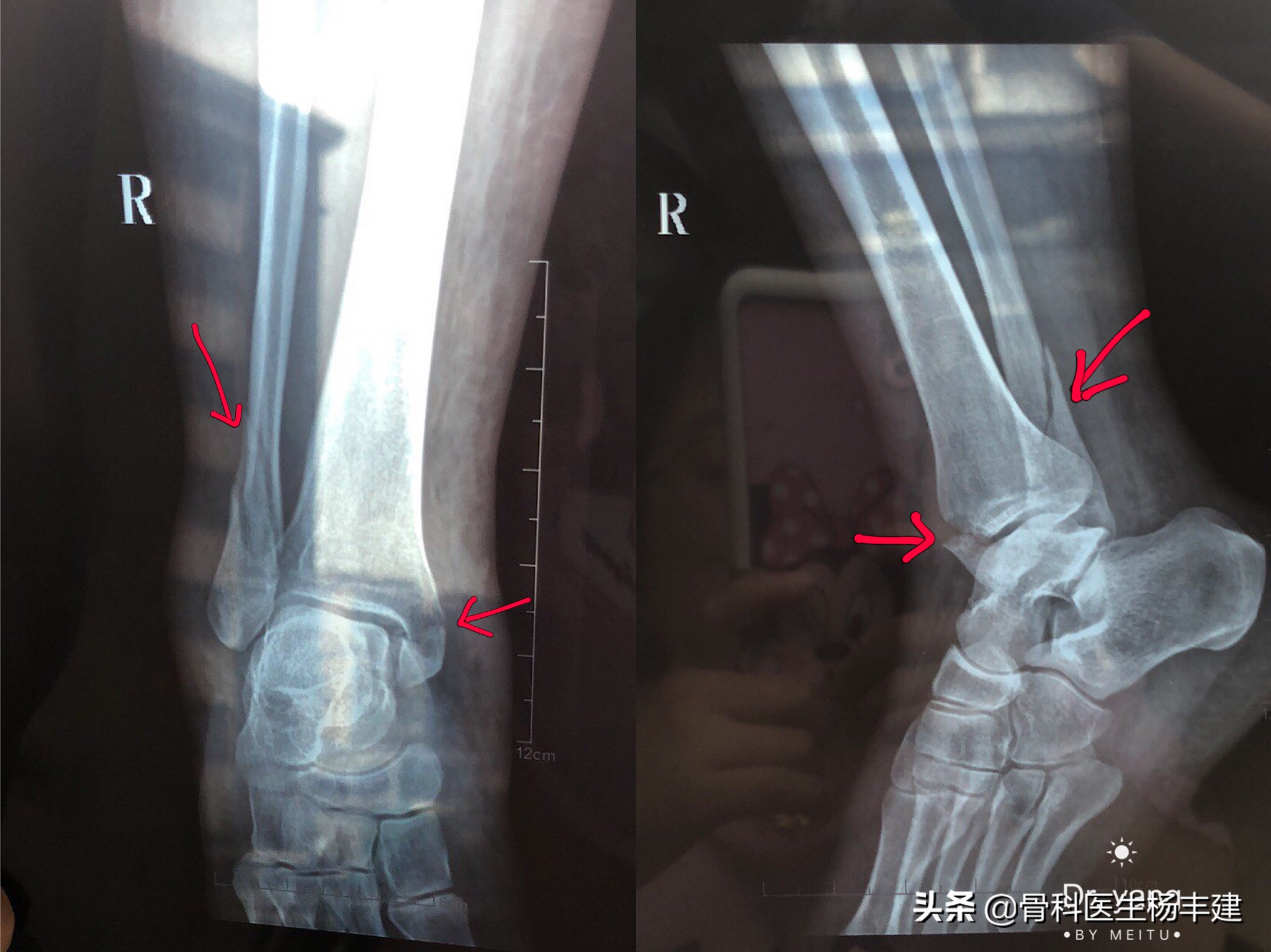 什么样的脚踝骨折适合保守治疗,什么样的腿骨骨折需要手术