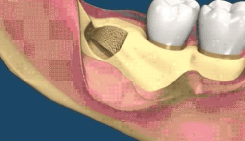 拔了一颗智齿花了1300元贵吗,拔个智齿花了800