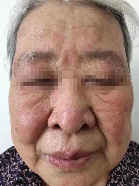 白癜风的正确看法,突然间长白癜风怎么回事