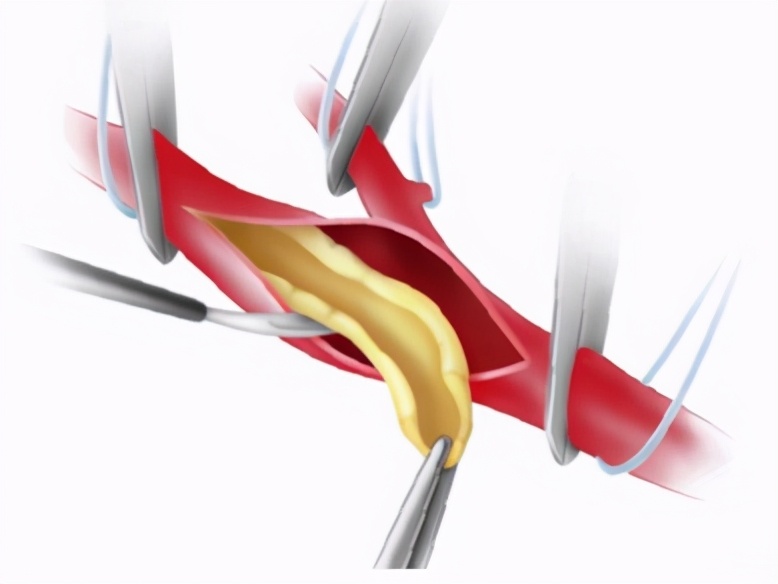 脑梗后癫痫会致人死亡吗,脑梗死的癫痫会引起牙齿痛吗