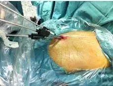 体检发现“肺小结节”怎么办？胸外科医生来谈一谈