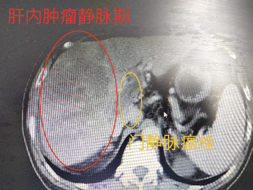 输血得了丙肝有赔偿吗,输血患丙肝医院要承担责任吗