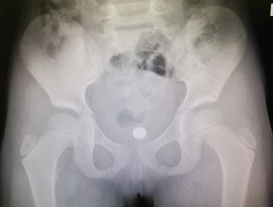 四岁小男孩往小丁丁里塞弹珠?那些年孩子塞进去的东西远不止这个