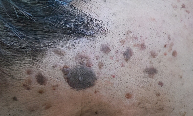 脸上有斑用什么护肤品祛斑效果好,40岁女人脸上长斑怎样有效祛斑