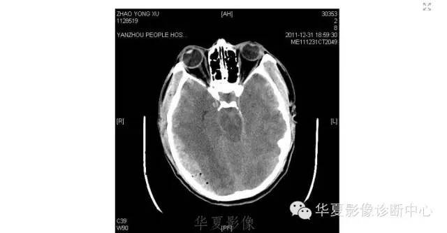 一文读懂颅内胆脂瘤,一文看懂背后的真相