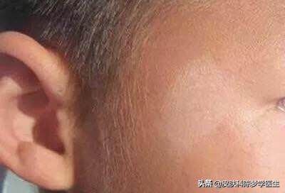 脸上有白斑好几年了会是白癜风吗,皮肤白斑和白癜风的区别