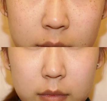 脸暗黄有斑用什么牌子面霜好,长斑皮肤用什么牌子的面霜好