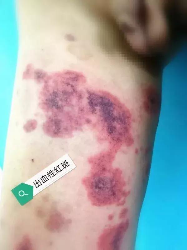 流感引起过敏性紫癜复发怎么办,过敏性紫癜可以打流感预防针吗