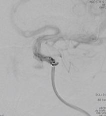 颈内动脉c3段动脉瘤是什么症状,右颈内动脉c3段动脉瘤是什么意思