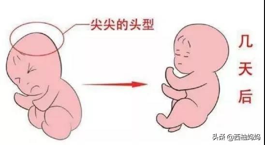 辟谣：“产瘤”十一天还没有消失，变硬就来不及了？要去抽出来？