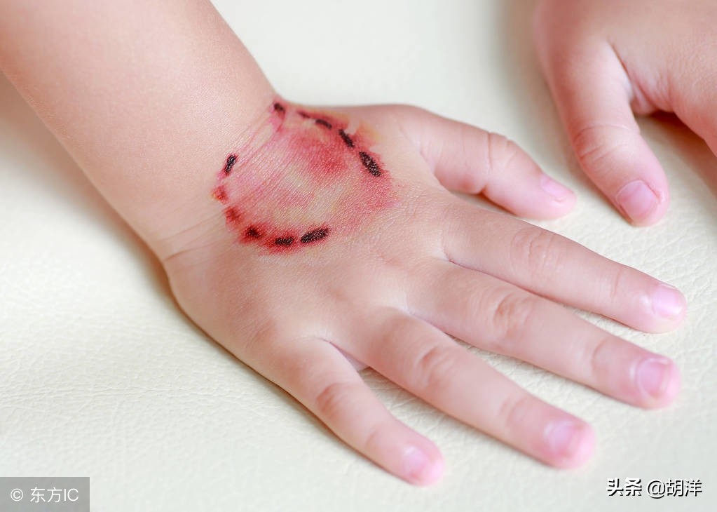 被狂犬病咬了不打疫苗可能存活吗,狂犬病发病时被咬才会感染吗