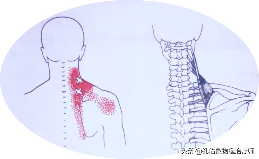 后背肩胛骨疼什么原因造成的,右后背肩胛骨下角疼痛部位对照表