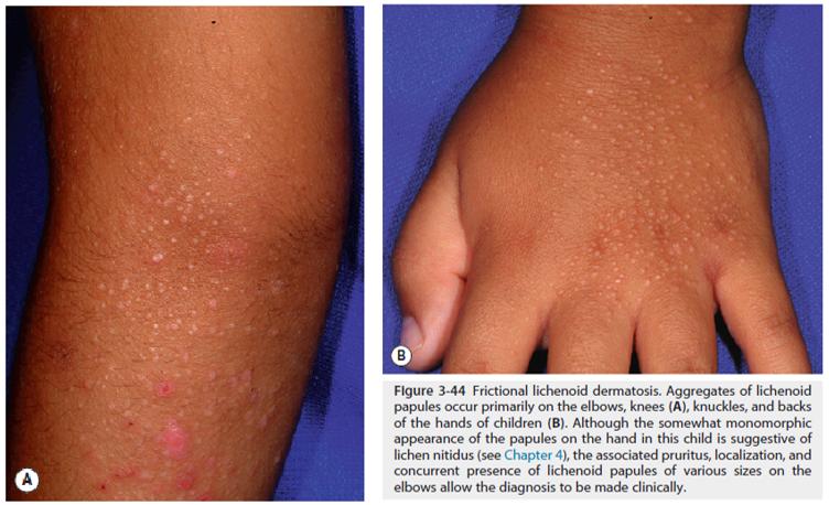 手上长一片小疙瘩还痒是怎么回事,天一热手上就起一层小疙瘩还很痒