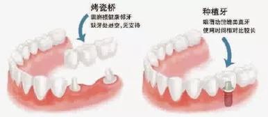 牙齿残根算牙齿缺失吗,口腔有缺失牙不处理好吗