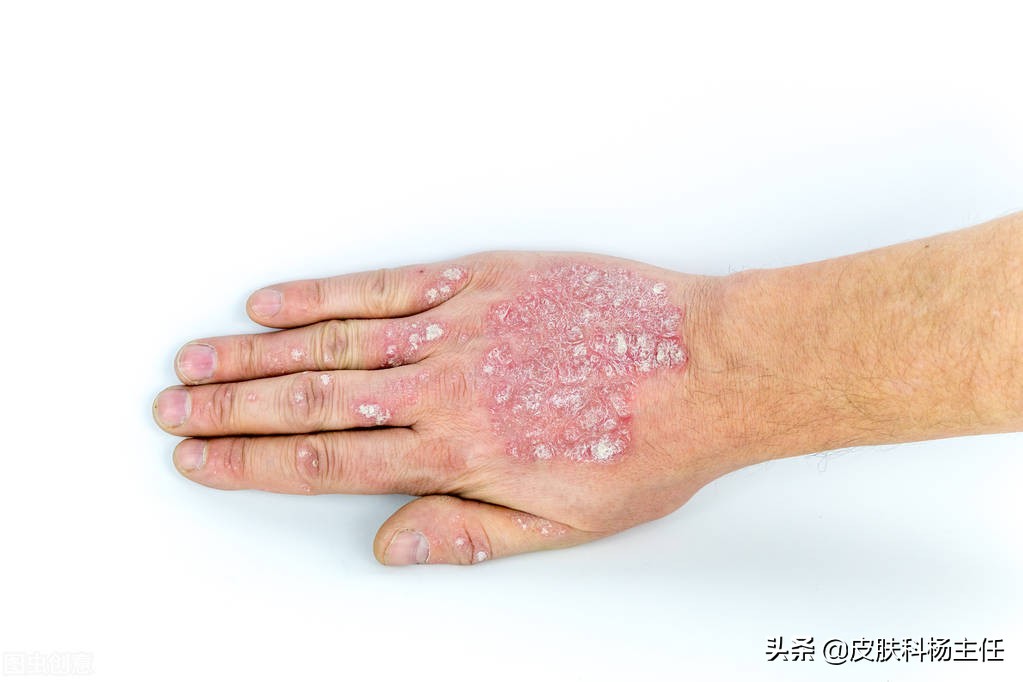 牛皮癣银屑病痒么,顽固性牛皮癣是银屑病吗