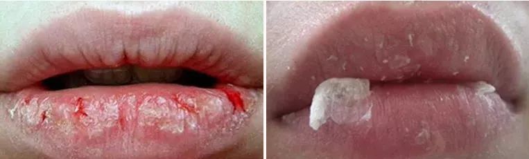 嘴唇不再干燥起皮温和润唇,秋冬唇干燥起皮