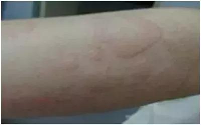 荨麻疹千万不要吃抗过敏的药,荨麻疹别不当回事小心伴随着肝炎