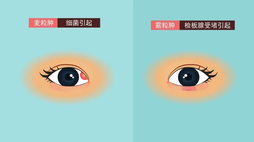 霰粒肿眼睛肿了怎么办,眼睛疼要长麦粒肿怎么预防