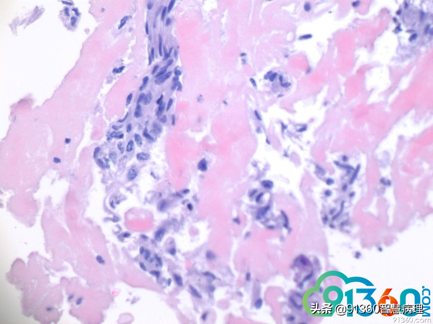 宫颈病理tct是什么检查,tct出现ascus会是宫颈癌吗