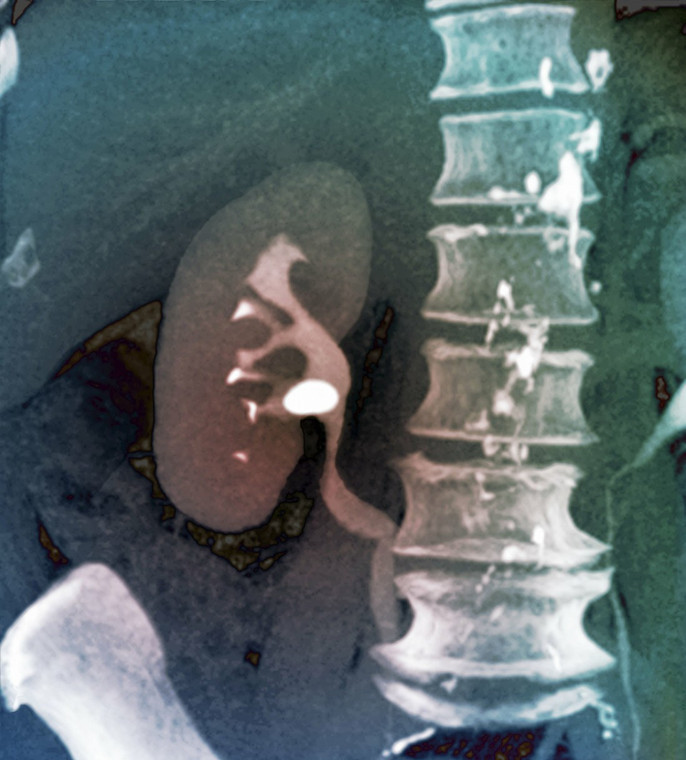 发现血尿,血尿痛是什么原因引起的