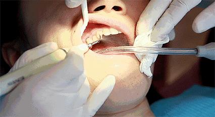 牙蛀了必须根管吗,牙蛀到什么程度需要补牙