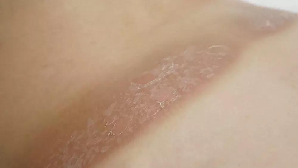 脸晒黑了简单快速变白,太阳晒黑怎么快速变白