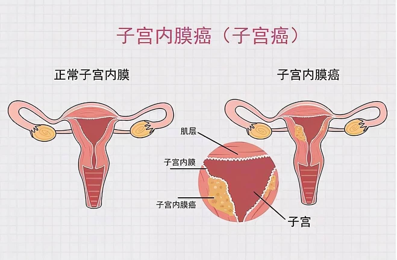 25岁女生以为怀孕，却查出子宫内膜癌！医生：两者症状要区分
