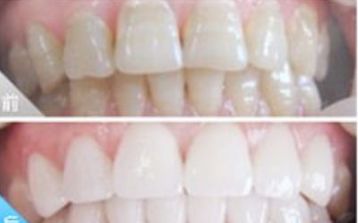 二氧化锆牙齿能做ct和核磁共振吗,氧化锆全锆牙冠能做核磁共振吗